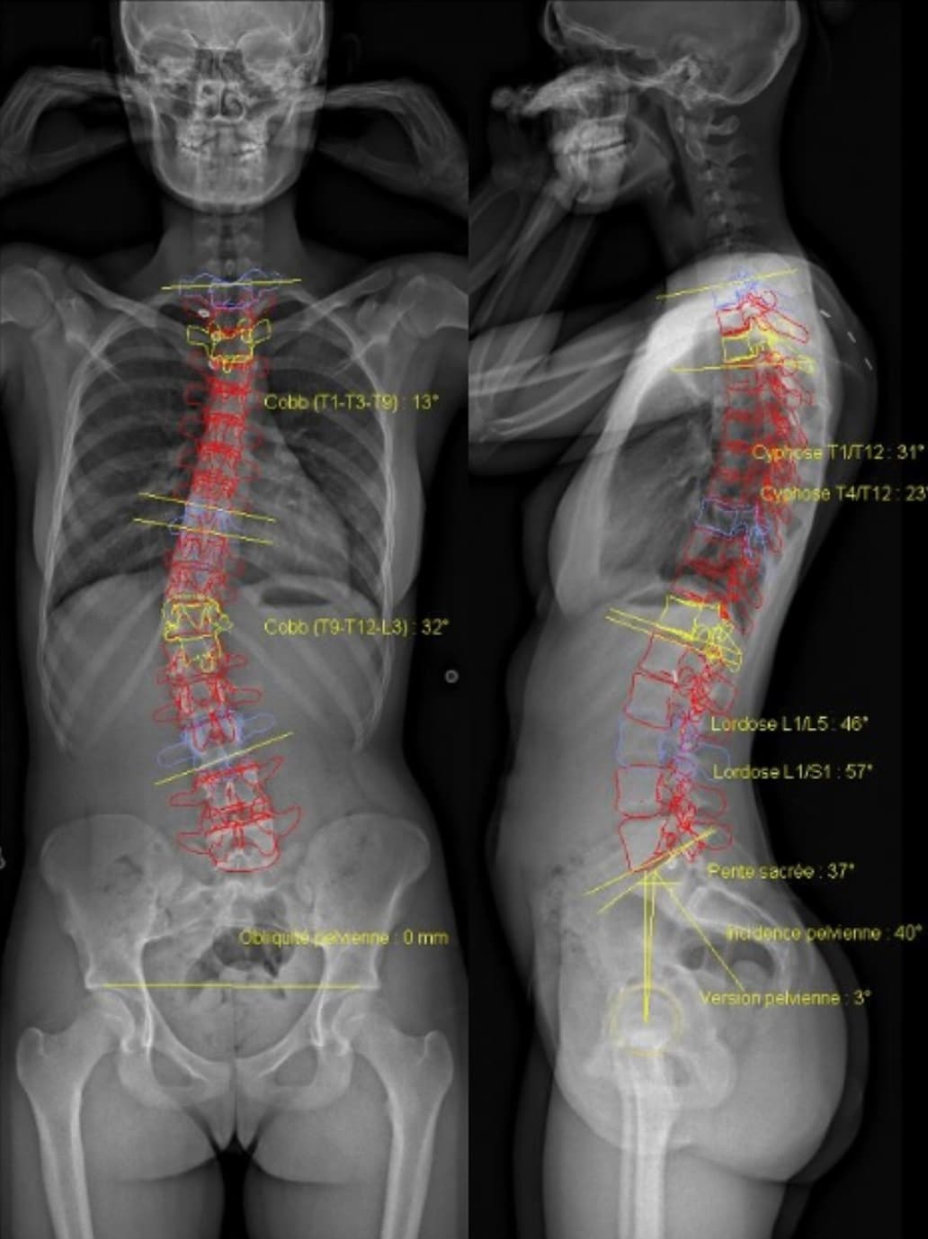 Radiographie EOS Avec IM2P - Imagerie Médicale Côte D'Or Et Jura